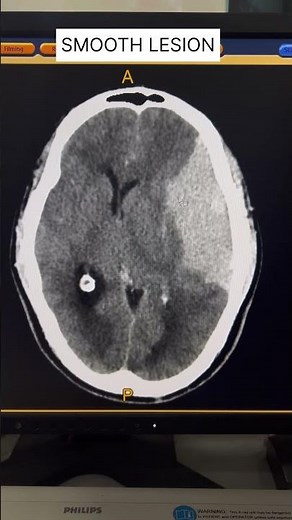Meningioma CT Brain Extra Axial Lesion #shorts