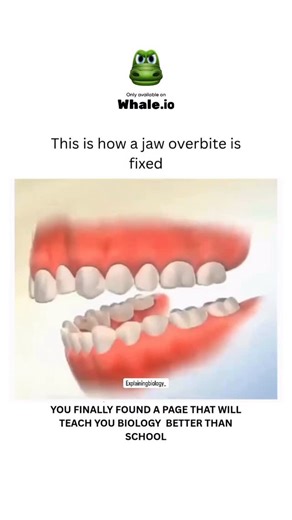 BIOLOGY | MEDICAL | HEALTH on Instagram: "This device is known as the Herbst appliance, used for correcting jaw overbite. It guides the lower jaw to grow into proper position. It can cause some discomfort or soreness initially as it affects jaw movement and teeth, with patients feeling pressure. But it has advantages - it helps treat Class II malocclusion, enhances facial harmony, and improves biting and chewing. On the flip side, it has drawbacks like causing initial discomfort, needing proper 