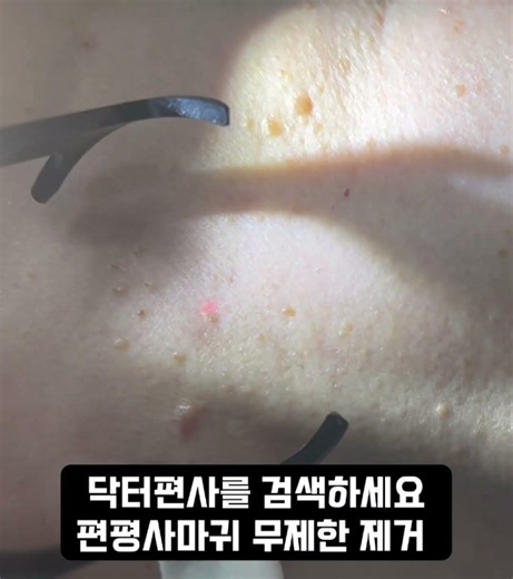 #레이저시술 #편평사마귀 #편평사마귀무제한제거 #닥터편사 #편사성지