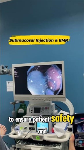 Fast & Clean EMR: JNET 2A Colonic Polyp with Prophylactic Clipping