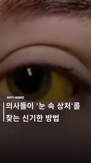 👁️ 눈의 미세한 상처까지 찾아내는 기술, ‘형광검사(Fluorescein Test)’ 의사들은 ‘플루오레세인 나트륨(Fluoresceína Sódica)’이라는 형광 염료를 사용해 눈 속의 보이지 않는 상처나 이물질을 찾아냅니다. 💡 눈에 염료를 한 방울 떨어뜨리면, 손상된 부위가 염료를 흡수하고 푸른 빛의 특수 조명 아래서 초록빛으로 반짝이며 드러납니다. 이 기술은 응급실에서 몇 초 만에 먼지, 유리조각, 손톱 등으로 생긴 눈의 손상을 정확히 찾아내는 데 사용됩니다. ✅ 통증 없이, 빠르고, 정확하게. 보이지 않던 위험을 눈으로 확인할 수 있는 의학의 작은 기적입니다. #눈건강 #안과상식 #형광검사 #플루오레세인 #응급의학 #시력보호 | antiaging.kr