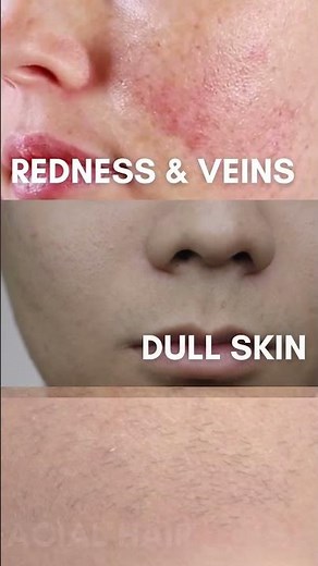 Transforming Skin One Picosecond At A Time with Pico Clarity Laser