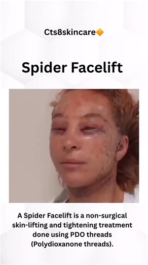 🕸️ 🧏🏻‍♀️What is a Spider Facelift? The Spider Facelift is a non-surgical skin-lifting technique that uses ultra-fine PDO threads placed underneath the skin in a delicate spider-web pattern. This pattern supports loose skin, stimulates collagen production, and gradually improves firmness—giving a natural, youthful lift without surgery. ✨ How it works: The PDO threads act as a structural net, instantly providing subtle lift to sagging areas like the cheeks, jawline, smile lines, and lower face.