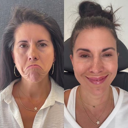 Botox Before and After at Skin Deep Houston Texas