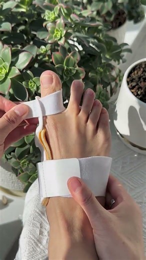 Correct Bunions Fast with This Toe Alignment Splint Pain Relief Solution