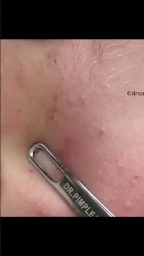 Tough Blackheads
