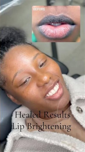 Lip Brightening — healed result after 1 year💋