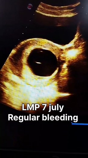 15K views · 81 reactions | LMP 7 july regular bleeding #ultrasoun #UltrasoundTips #ultrasoundscan #RadiologyJobs #radiographer #fetus #radiology #ultrasoundvideo #ultrasoundcavitation #doctor #radiologylife #ultrasoundtechnician #ultrasoundtech #ultrasound | Arshad Khan | Facebook