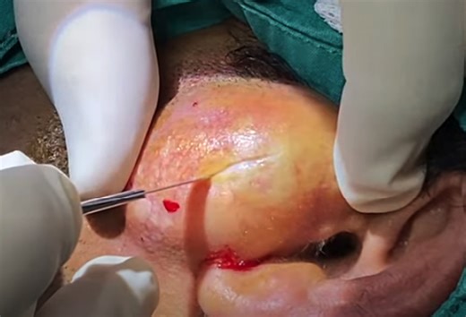 Sebaceous Cyst on Parotid Region Drained
