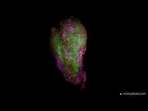 Light sheet microscopy image of pancreatic carcinoma cell line with infiltrating CAR T cells