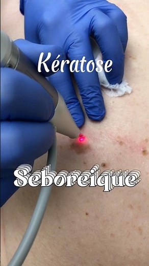 KÉRATOSES SÉBORRHÉIQUES - Traitement efficace