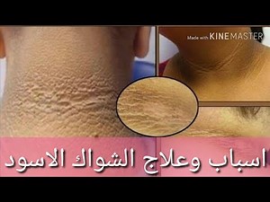 الشواك الاسود 👈 اسمرار حول الرقبة 👈 عرض ولا مرض 🤔 الأسباب و العلاج Acanthosis Nigricans