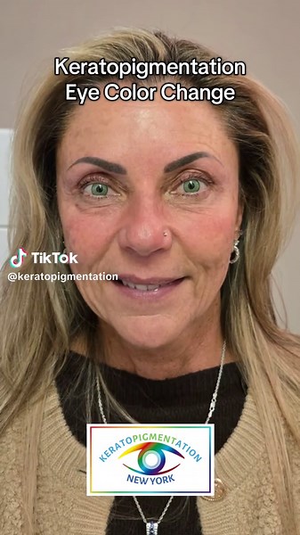 Keratopigmentation: Change Your Eye Color Uniquely