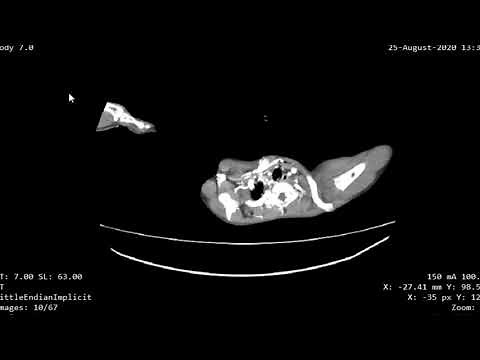 Case 945 CT Chest lung contusion