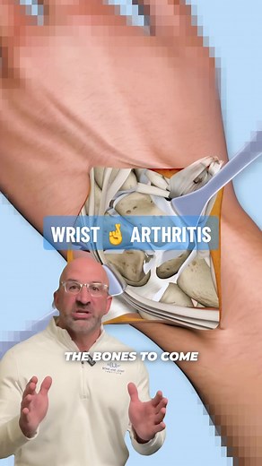 Wrist Arthritis Pain Relief Option 🤞 Four-corner wrist fusion is a motion sparing procedure used to treat osteoarthritis secondary to advanced scapholunate collapse or longstanding scaphoid nonunion advanced collapse. Among the various procedures for degenerative carpal (wrist bone) lesions, four-corner fusion relieves pain while conserving motion and strength and there are various fixation options. . Four-corner #wristfusion has been shown to reduce the patient’s pain and preserves ~50% of opp