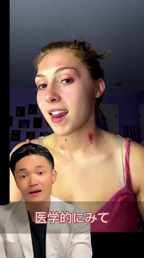 How to Remove Kiss Marks Fast and Easy