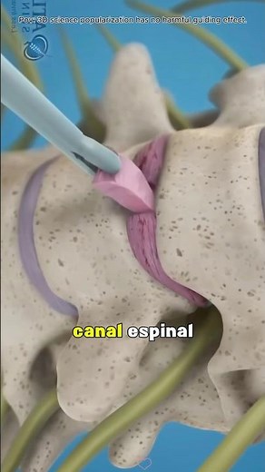 how Lumbar Laminectomy is done(3D Animation)#medical3danimation #3dmedicalanimation