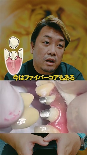 神経治療のメタルコアを歯医者が解説【歯医者】