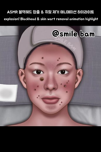 블랙헤드 제거 애니메이션 ASMR