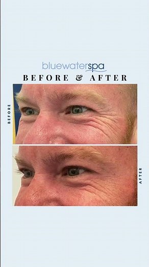 Before and After Botox | Blue Water Spa | Raleigh NC