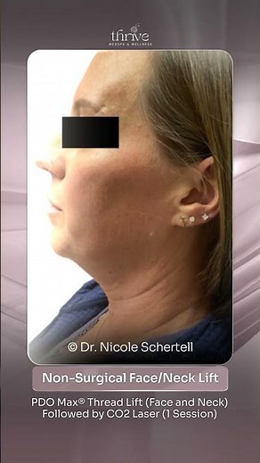 Non-Surgical Face/Neck Lift with PDO Thread Lift