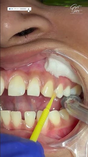 Invisalign | Invisalign Before and After | Invisalign or Dental Braces- #invisalign #invisalignsmile