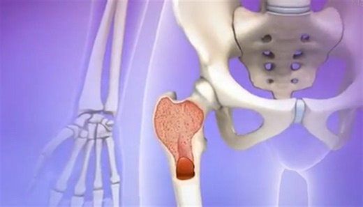 What you need to know about cancer and anemia