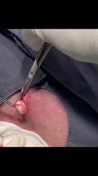 PULLING OUT A CYST - CYST PULL - REMOVING A CYST