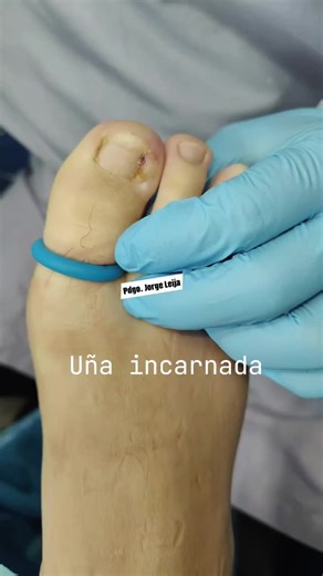 Todo sobre la uña encarnada y su tratamiento