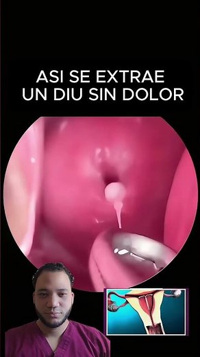 ¿Cómo se saca un DIU sin dolor?
