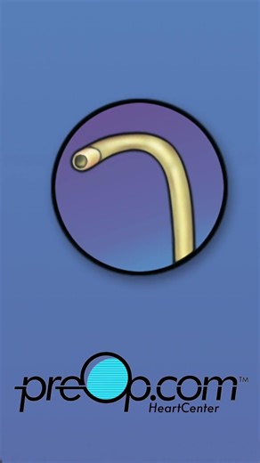 PreOp® Heart Stent (PCI) Patient Education | Cath Lab Flow, Risks, and Aftercare #shorts