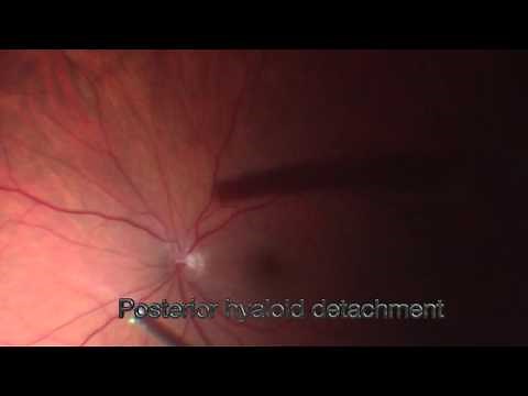 Optic Disc Pit Maculopathy • Video • MEDtube.net