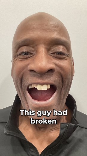 😬🦷 This Guy Had Broken and Brittle Teeth... 🦷😬 struggling with broken and brittle teeth after neglecting to floss and brush. He was faced with two options—dentures or dental implants— this would be a life-changing choice. He chose permanent teeth in 24 hours for a strong, reliable solution. Now, he's savoring his favorite foods, speaking with ease, and beaming with confidence. 🙌 Dive into his incredible journey and witness how dental implants have completely transformed his life! Would you 