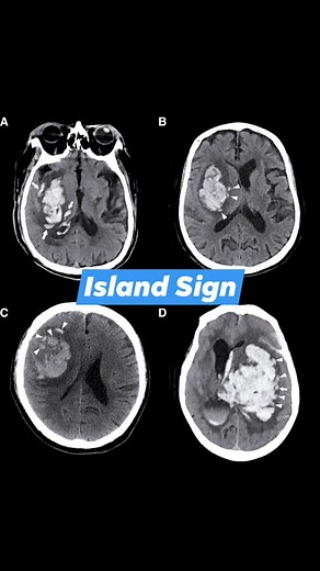 Hematoma expansion sign in brain #Swirlsign #NeuroSpineCare | CT Scan and MRI study