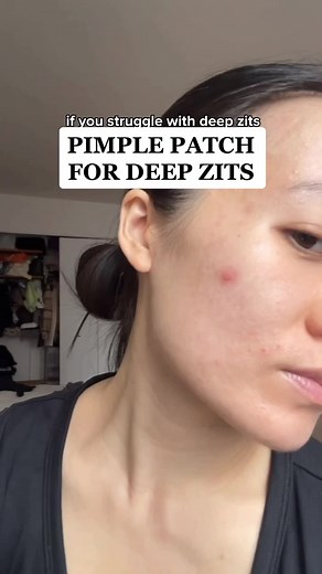 Effective Pimple Patches for Deep Zits