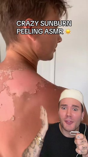 Crazy Sunburn Peeling ASMR Experience