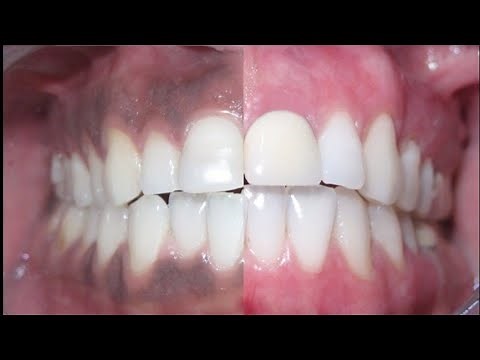 How to get rid of #DARK GUMS? causes & treatment for #blackgums