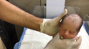 Newborn Baby Initial Assessment RBS Monitoring & Oral Inj K-Lot Administration NICU observation CARE #baby #babycare #babyboy #twinbabies In this video, we demonstrate the initial assessment of a cute newborn baby, focusing on Random Blood Sugar (RBS) monitoring and the administration of oral Inj. K-Lot (Vitamin K). These steps are crucial in early neonatal care to prevent hypoglycemia and bleeding disorders. Included Procedures: •⁠ ⁠RBS check using heel prick method •⁠ ⁠Oral administration of V