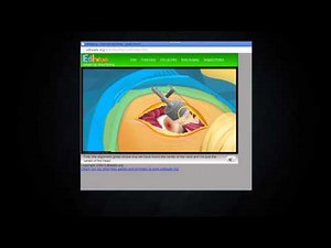 Virtual Hip Resurfacing