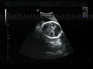 Dandy-Walker Syndrome which is a congenital brain malformation involving the cerebellum