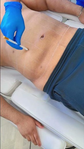 How to inject Lemon bottle fat dissolving injection on abdomen. #fatdissolving #lemonbottleinjection