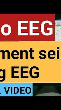 Video EEG documenting seizure during EEG