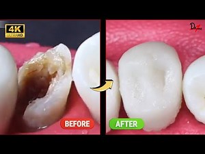 AMAZING Premolar Root Canal Treatment #asmr