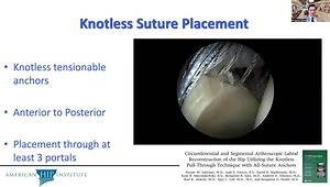 Management of the Labrum