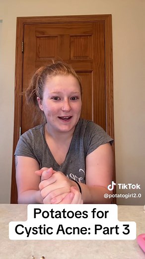 Potato Skincare for Cystic Acne: Part 3 Update
