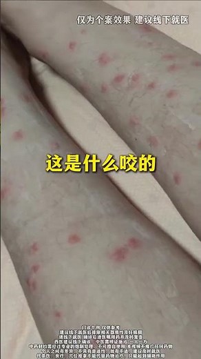 Mosquito Bite Differences: Doctor's Guide to Tell Them Apart