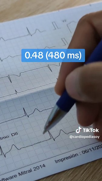 Fórmulas de Bazett y Fridericia (recomendada en electros con FC >100) para calcular el QT corregido (QTc) Además algunas tablitas con valores de referencia Y la calculadora miniweebtool de utilidad para calcular la raíz cúbica En el siguiente video, compararemos resultados con la App “Calculadora QTc” @Dr. CardioPedia #QTc #EKG #ECG #electro #medicina #cardio #cardiopedia #cardiopediasoy #desaprendemedicina #qtcorregido #bazett #fridericia #electrocardiograma #cardiologia