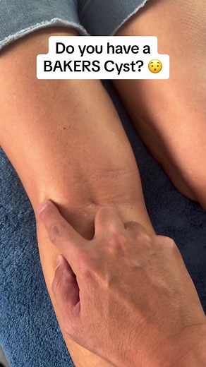 Do you have a Bakers Cyst? What is it? Does it need surgery? What is the pain with it? #bakerscyst #kneepain #behindthekneepain #whatisit #nervelocks