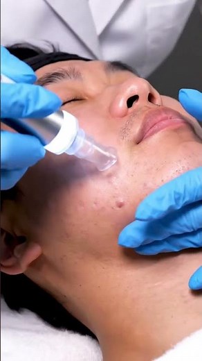 “This Vacuum Removes Everything 😳 | Deepest Blackhead Pops!”