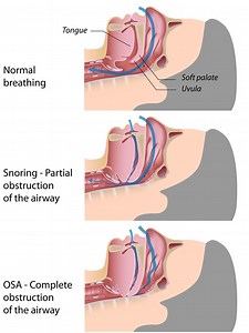 Obstructive Sleep Apnea in Children